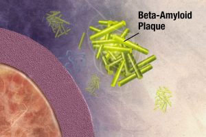 illustrazione della beta amiloide