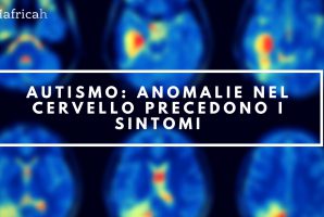 autismo anomalie cervello